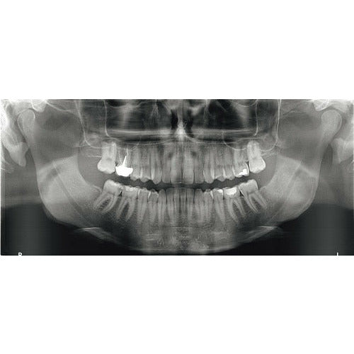 CARESTREAM CS 8100 3D PANOREX + CONE BEAM