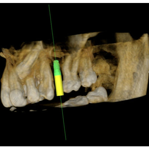 CARESTREAM CS 9300 PREMIUM PANOREX + CEPH + CONE BEAM