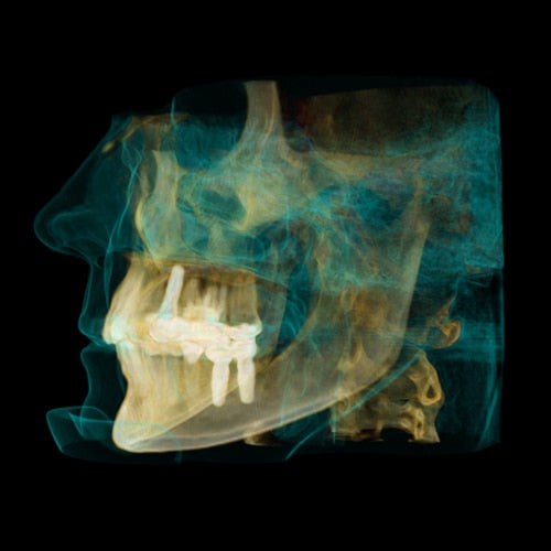 CARESTREAM CS 9300 PREMIUM PANOREX + CEPH + CONE BEAM