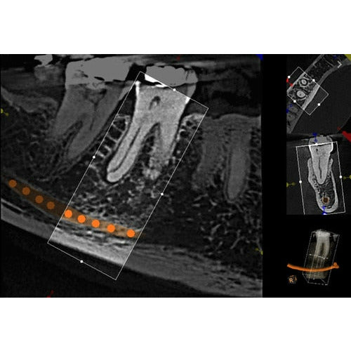 CARESTREAM CS 9300 PREMIUM PANOREX + CEPH + CONE BEAM