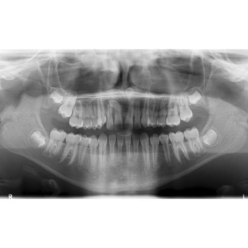 CARESTREAM CS 9000C 3D PANOREX + CEPH + CONE BEAM