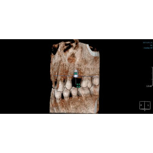 GENDEX GXDP-700 PANOREX + CEPH + CONE BEAM