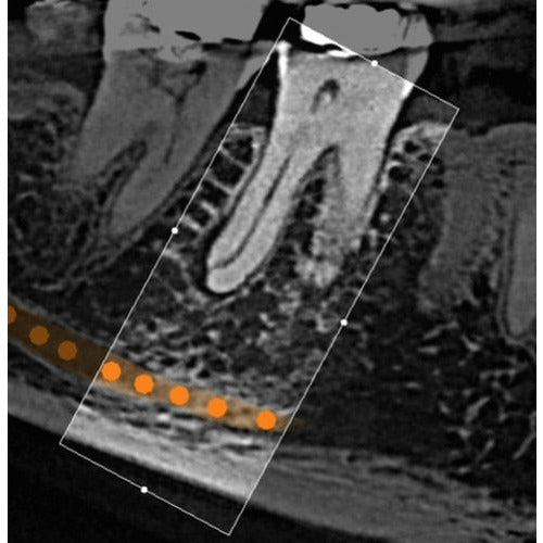 CARESTREAM CS 8100 3D PANOREX + CONE BEAM