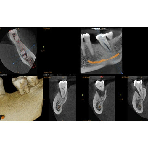 CARESTREAM CS 8100 3D PANOREX + CONE BEAM