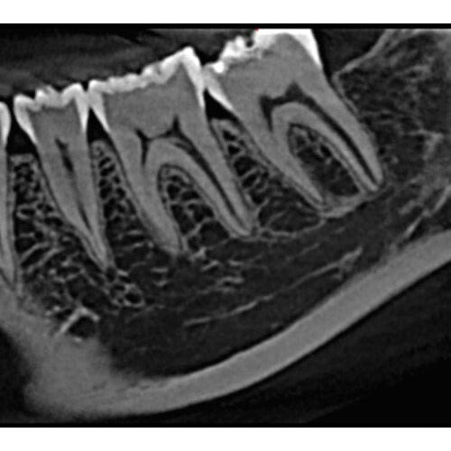 CARESTREAM CS 8100 3D PANOREX + CONE BEAM
