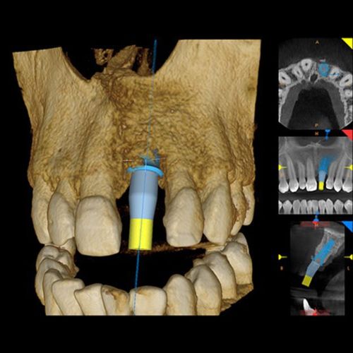 CARESTREAM CS 8100 3D PANOREX + CONE BEAM