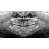 CARESTREAM CS 8100 3D PANOREX + CONE BEAM