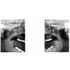 GENDEX GXDP-700 PANOREX + CEPH + CONE BEAM